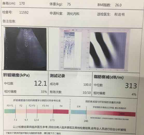 郑州什么医院看肝硬化好?郑州治疗效果好的肝硬化医院