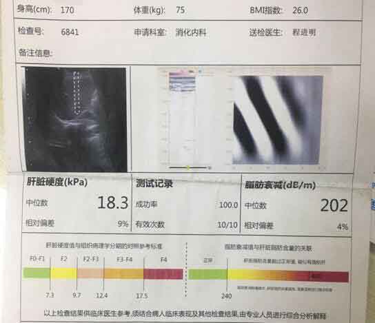 郑州什么医院看肝硬化好?郑州治疗效果好的肝硬化医院