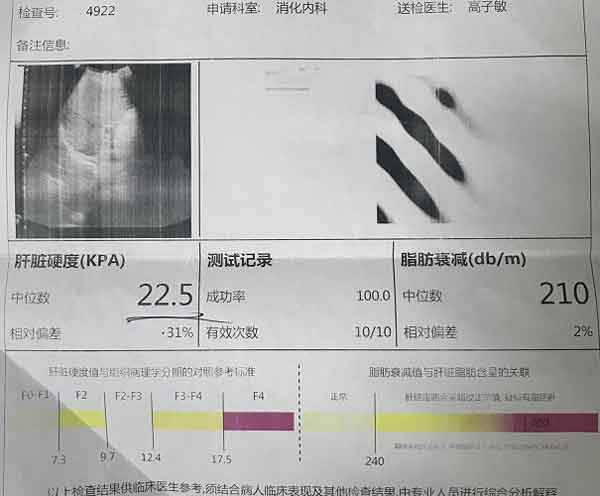 郑州哪家医院看肝硬化好