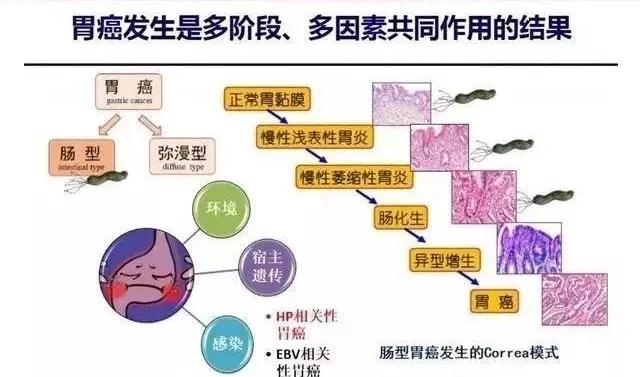 做胃镜很难受,你对胃镜的误解太深了